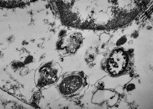 F,49y. | purulent meningitis- meningococcal v.s.